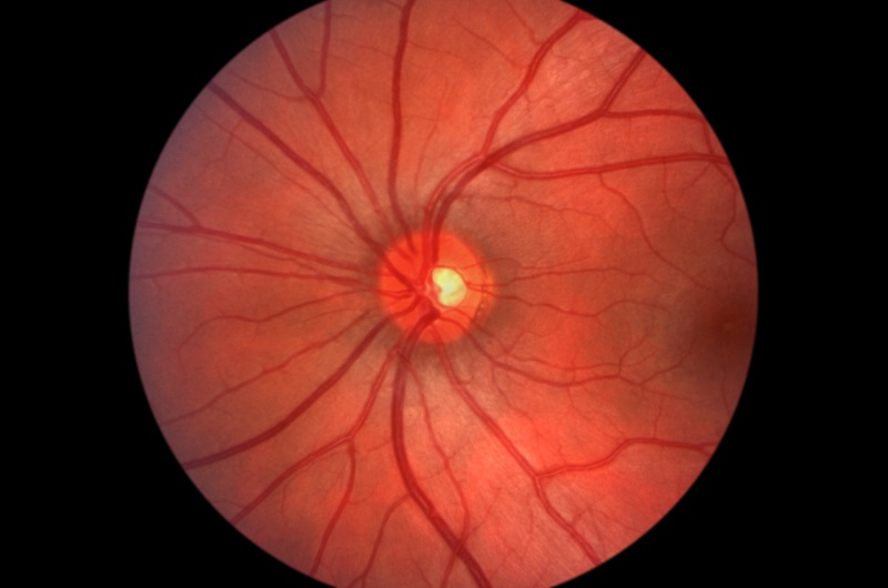 Glaucoma Coconut Creek, FL